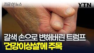 갈색으로 변해버린 트럼프의 손...'건강이상설' 언급에 전 세계 관심 [지금이뉴스] / YTN