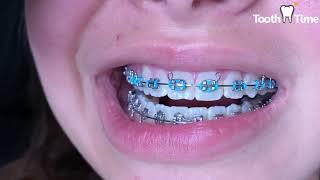 Braces Checkup - Fast Appointment Changing Elastics  - Tooth Time Family Dentistry New Braunfels