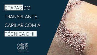 Etapas do Transplante Capilar Atraumático com a técnica DHI | Dr. Calixto