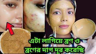 ব্রণ থেকে মুক্তি পাবে 1 দিনে 100 % গ্যারান্টি || bron dur korar upay || How To Remove Acne Pimple