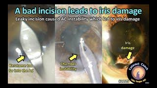 CataractCoach 1225: a bad incision leads to iris damage