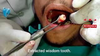 Surgical Extraction of Wisdom Tooth! Bright Line Dental Care Dr. Swostik Devkota Nepali Dentist