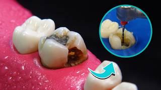 Tooth restoration: Root Canal Treatment and INLAY