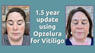 1.5 year update using Opzelura for Vitiligo & Phototherapy