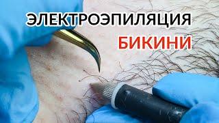 Электроэпиляция бикини - процесс / Electrolysis / електроепіляція