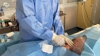 Femoral vein cannulation.
