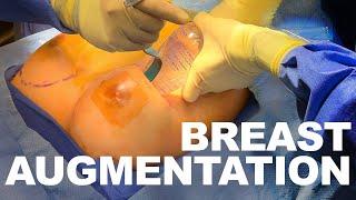 Breast Augmentation with Silicone Implants - Dr. Paul Ruff | West End Plastic Surgery