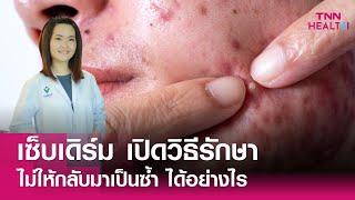 เปิดวิธีรักษา โรคเซ็บเดิร์ม ไม่ให้กลับมาเป็นซ้ำได้อย่างไร : TNN Health