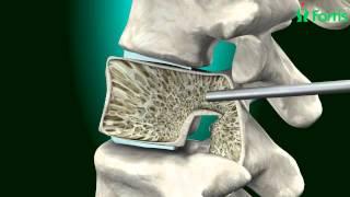 Vertebroplasty & Kyphoplasty ( Spine Surgery) Neuro Surgery; Fortis Healthcare,India