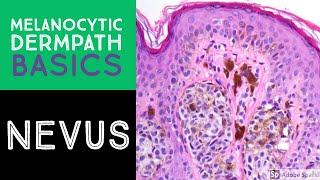 Melanocytic Dermpath Basics: Benign Nevus