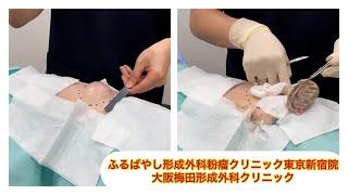 東京皮膚のできものと粉瘤クリニック　ふるばやし形成外科新宿院　大阪梅田形成外科クリニック ブログでも詳しく解説してます。　大きな腰の粉瘤　切開法