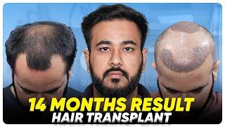 Hair Transplant in Chennai | Best Results & Cost of Hair Transplant in Chennai