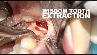 Wisdom tooth removal in 5 MIN or less. Surgical Guide: Online Course + Free e-Book!