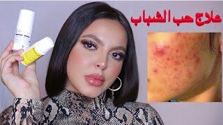 إزاي عالجت وشي من حب الشباب و نصايح للتخلص من آثار الحبوب محدش بيتكلم عنها | How I cleared my Acne