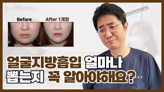 얼굴지방흡입 할 때 지방을 얼마나 빼냐구요?