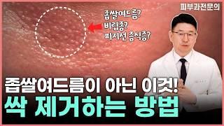 좁쌀여드름이 아니라고? 눈밑의 닭살처럼 보이는 피지선 과형성증! 원인부터 치료방법까지 알려드립니다