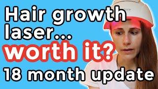 iRestore hair growth laser 18 month update. Is it worth it?| Dr Dray