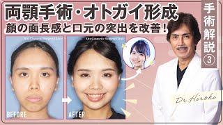 両顎手術とオトガイ形成術を受けた20代の女性の症例を詳しく解説！③【リッツ美容外科 廣比 利次 医師】