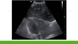 UH CMC ED - ultrasound cases: #1 cardiac arrest