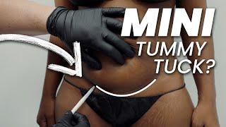 Mini Tummy  Tuck vs Full Tummy Tuck