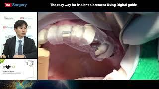 Dentium 221021 Live Surgery - The easy way to implant placement using Digital guide