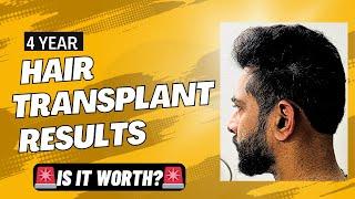My 4 Years Hair Transplant Results  #ameerht #hairfall