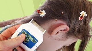 The Best Way to Remove Lice? Honest RobiComb Review