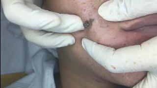 Nặn mụn kinh dị - Phần 6 - Không nên xem khi đang ăn