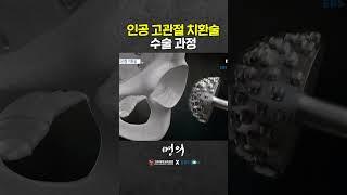 Hip Arthroplasty Surgery Method