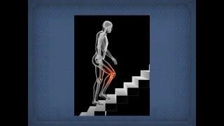 Knee Pain: Complex Causes of Patellofemoral Syndrome#knee,#osteoarthritis,#kinetic,#injury,#chain