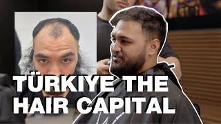 Is a hair transplants in Turkiye worth it? We hear about great and not so great results | Short Doc