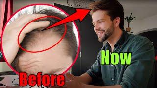 How I Stopped Balding! (no Hair Surgery)