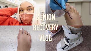 BUNION RECOVERY VLOG #2: Getting Stitches Taken Out | Pain + Swelling | New Boot!