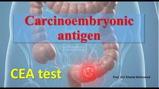 Carcinoembryonic antigen (CEA) test