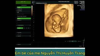 EM BÉ CỦA MẸ NGUYỄN THỊ HUYỀN TRANG - ĐẠI ĐỒNG VĨNH TƯỜNG VĨNH PHÚC - THAI 11 TUẦN 6 NGÀY