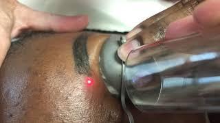 Laser microblading removal of eyebrows on black female