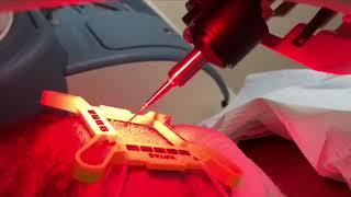 LIVE ARTAS Robotic Hair Transplant Procedure - ARTAS in Action