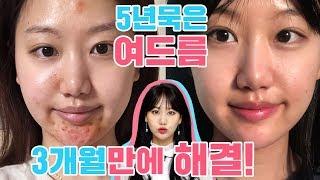 화농성&염증성 여드름 없애는 방법 및 성인여드름관리방법 (feat. 시술 저리가라 / 오롯이 나의 경험담)