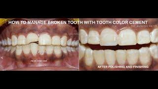 composite done in farctured anterior tooth