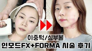 인모드FX+FORMA 시술 후기｜통증｜멍｜효과｜심부볼 이중턱｜주기｜그레인grain