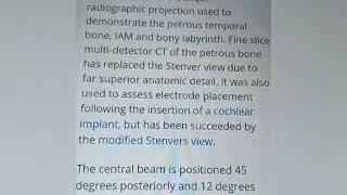 Stenvers view of mastoid.