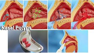 Nasal polyps treatment and surgery! 3d medical animation|Dandelion Team #nasalpolyp #noose