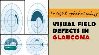 FIELD DEFECTS IN GLAUCOMA | arcuate, paracentral, nasal step, temporal wedge, baring of blindspot...