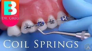 [BRACES EXPLAINED] Coil Springs