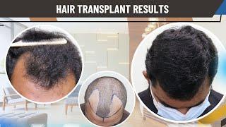 Hair Transplant In Shimoga | Best Clinic Center surgeon & Results Of Hair Transplant In Shimoga