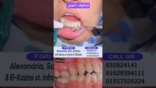 Dental Scaling | تنظيف جير الاسنان بعد التقويم #في #امل #مع #دكتور_اسلام_نبيل #لايك #اكسبلور