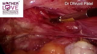 Total Laparoscopic Hysterectomy