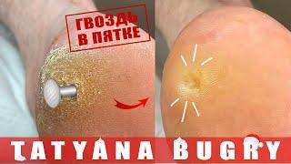 35 YEAR OLD CALLOUS  Removing Callouses & Super Deep Corns PART 2 #TatyanaBugry