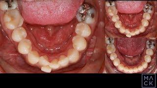 Severe Crowding in an Adult Treated with Braces and no Extractions