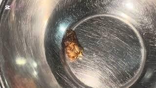 Firmly impacted Wax causing hearing loss and irritation ,patient regain hearing after safe removal.